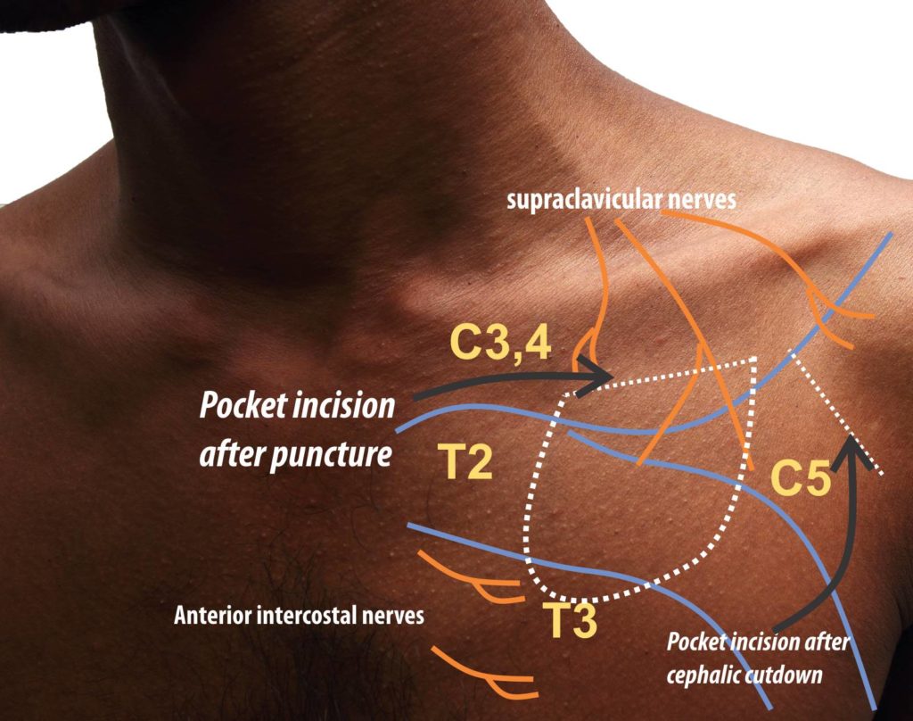 Local Anesthesia – How to Pace