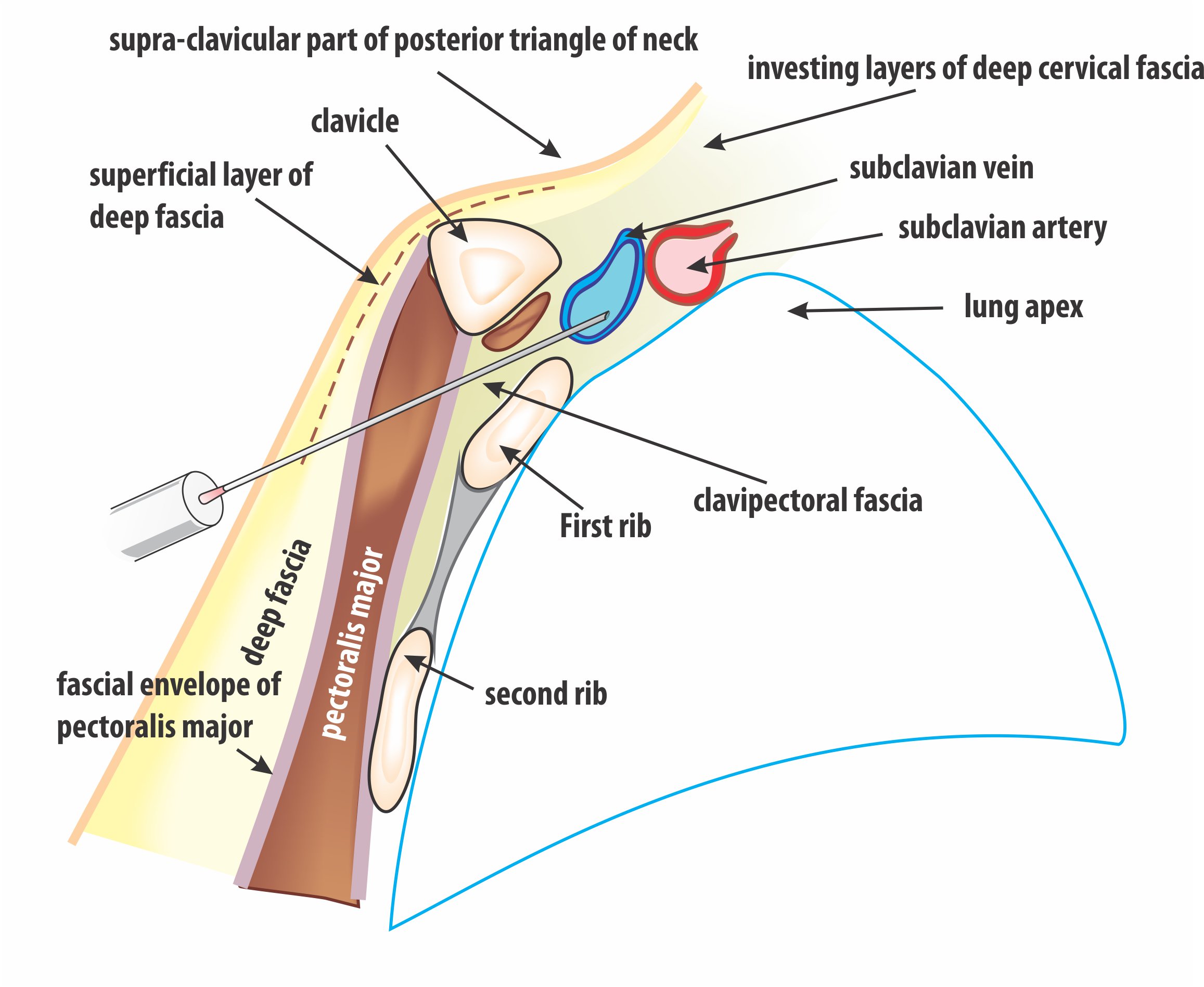 Subclavian Puncture How To Pace