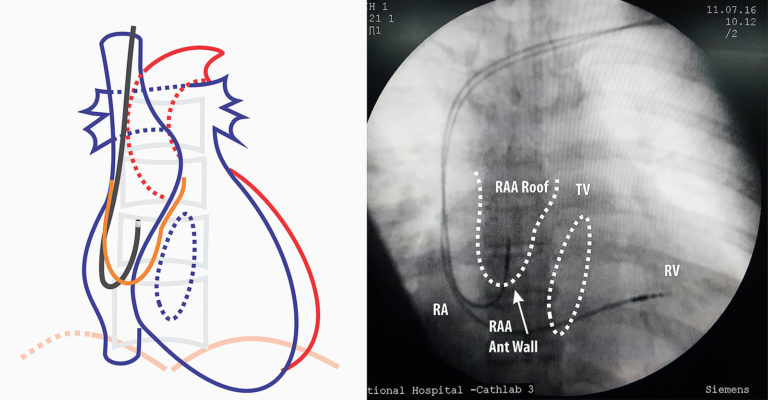 Atrial Pacemaker – How To Pace